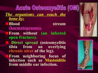 The organisms can reach the
bone by:
Blood stream
(haematogenous).
From without (an infected
open fracture).
Direct spread (osteomyelitis
tibia from an overlying
chronic ulcer of the leg).
From neighboring focus of
infection such as Mastoiditis
from middle ear infection.
 