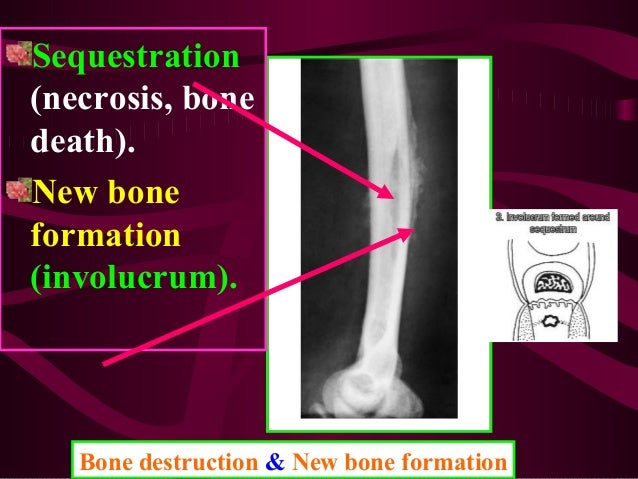 Strep infection in bone