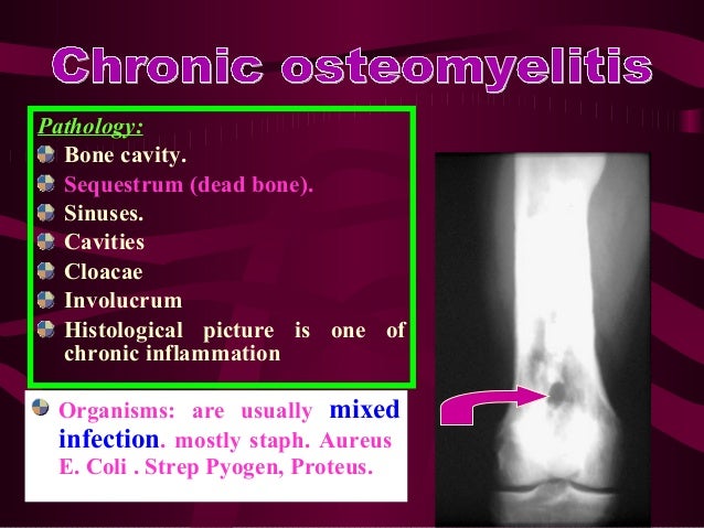 Strep infection in bone