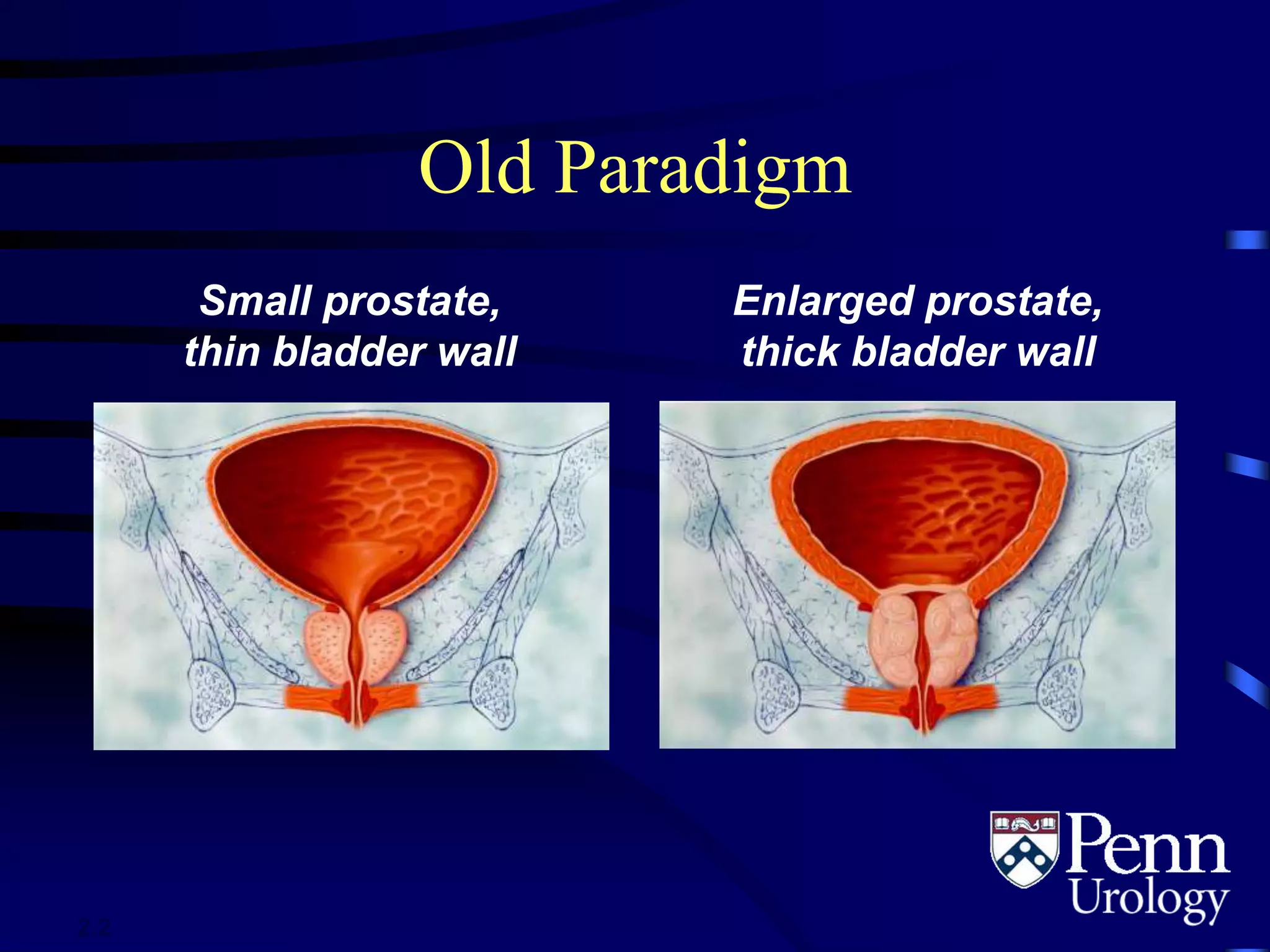 Old Paradigm
Small prostate,
thin bladder wall
Enlarged prostate,
thick bladder wall
2.2
 