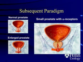 Subsequent Paradigm
Normal prostate
Enlarged prostate
Small prostate with -receptors
2.3
 