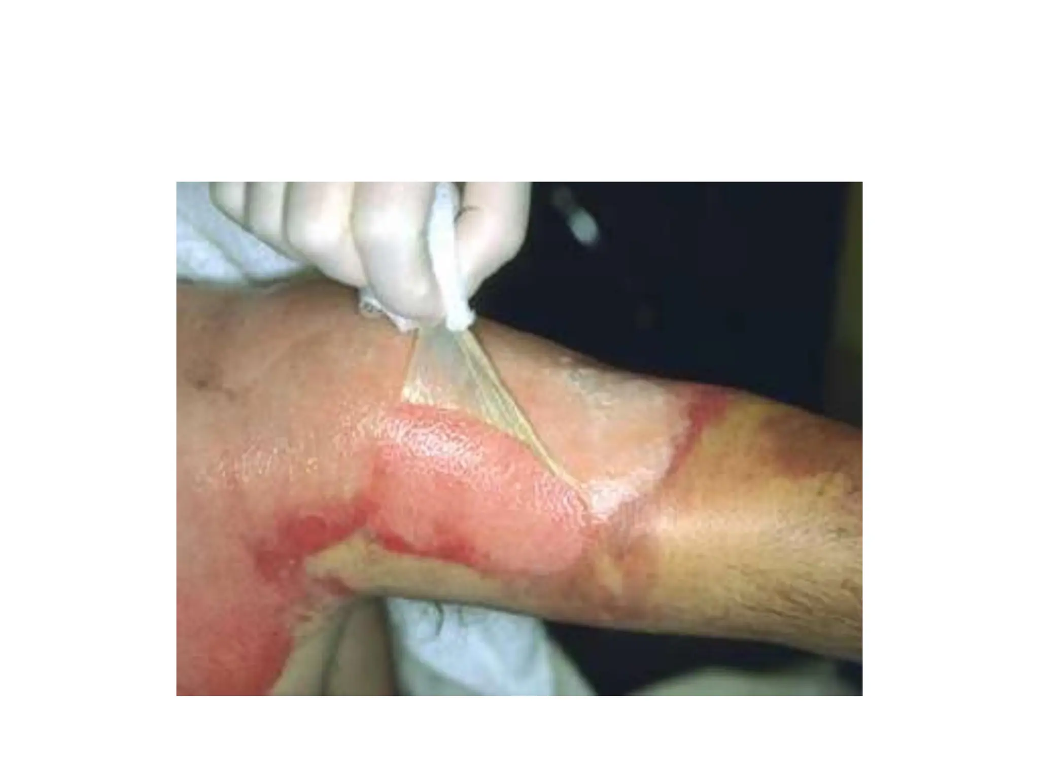 1-BURN of skin and tissue and muscles and bone | PPT