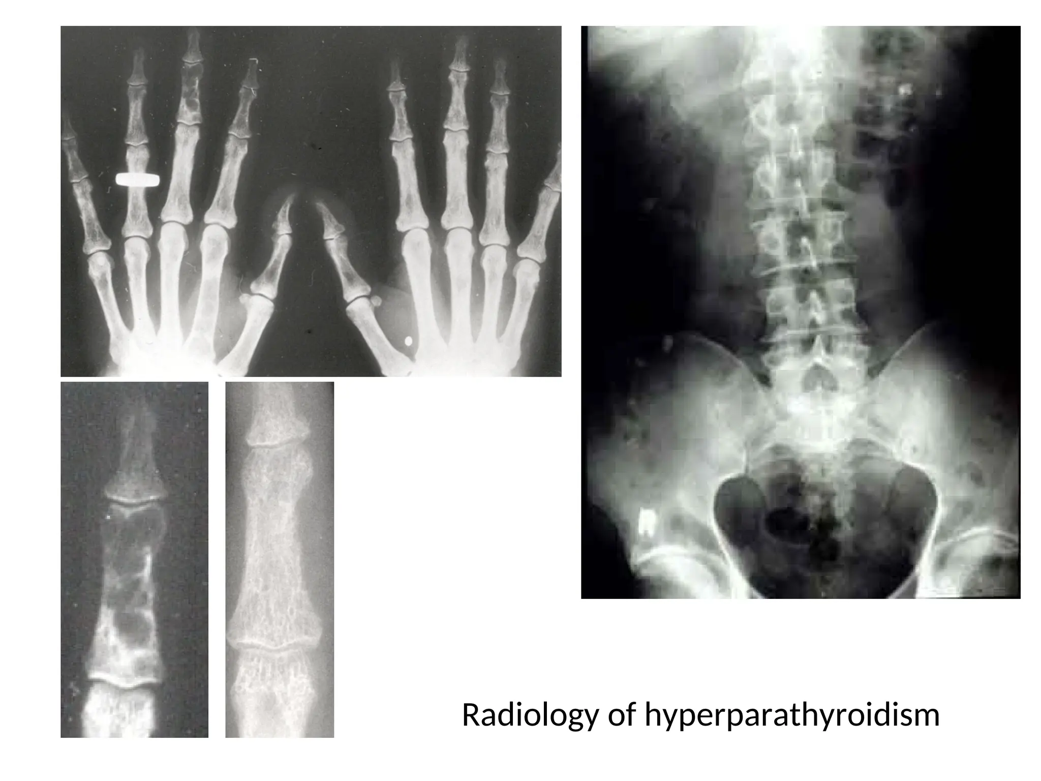 Radiology of hyperparathyroidism
 