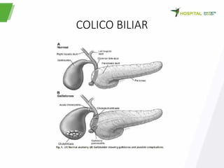 COLICO BILIAR
 