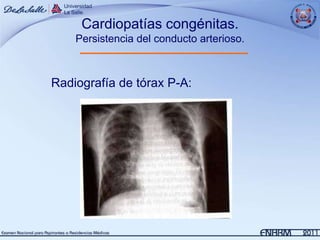 Cardiopatías congénitas.
    Persistencia del conducto arterioso.



Radiografía de tórax P-A:
 
