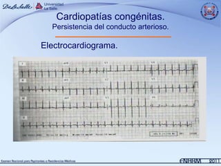 Cardiopatías congénitas.
  Persistencia del conducto arterioso.

Electrocardiograma.
 