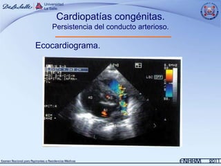 Cardiopatías congénitas.
   Persistencia del conducto arterioso.

Ecocardiograma.
 
