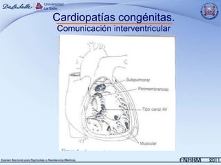 Cardiopatías congénitas.
Comunicación interventricular
 