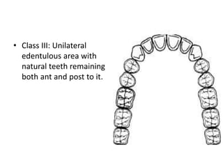 Edentulous Class Rpd 1-CLASSIFICATION OF RPD 1 copy.pptx