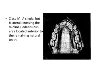 Edentulous Class Rpd 1-CLASSIFICATION OF RPD 1 copy.pptx