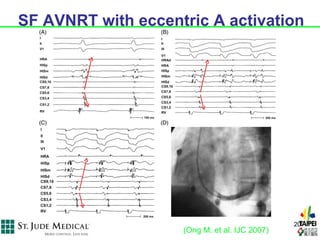 SF AVNRT with eccentric A activation




                                               20
                    (Ong M. et al. IJC 2007)
 