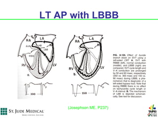 LT AP with LBBB




     (Josephson ME. P237)
 