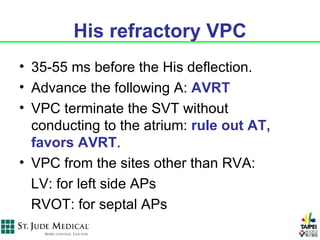 His refractory VPC
• 35-55 ms before the His deflection.
• Advance the following A: AVRT
• VPC terminate the SVT without
  conducting to the atrium: rule out AT,
  favors AVRT.
• VPC from the sites other than RVA:
  LV: for left side APs
  RVOT: for septal APs
 