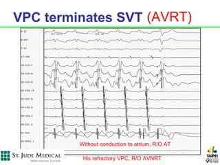 VPC terminates SVT (AVRT)




         Without conduction to atrium, R/O AT

          His refractory VPC, R/O AVNRT
 