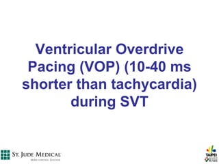 Ventricular Overdrive
 Pacing (VOP) (10-40 ms
shorter than tachycardia)
       during SVT
 