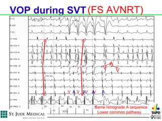 VOP during SVT (FS AVNRT)




                            A
                        V       V


          V A V AV AV   A


                    Same retrograde A sequence
                     Lower common pathway
 