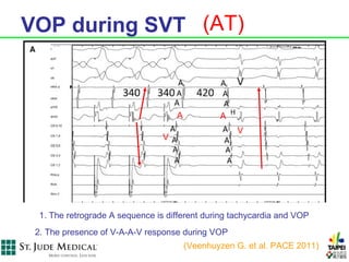 VOP during SVT (AT)



                                     A           A
                                                     V
                                 V




  1. The retrograde A sequence is different during tachycardia and VOP
 2. The presence of V-A-A-V response during VOP
                                         (Veenhuyzen G. et al. PACE 2011)
 