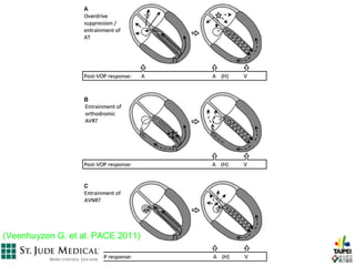 (Veenhuyzen G. et al. PACE 2011)
 