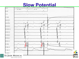 Slow Potential




                 34
 