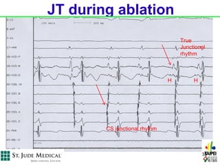JT during ablation
                                   True
                                   Junctional
                                   rhythm



                               H        H




        CS junctional rhythm



                                            35
 