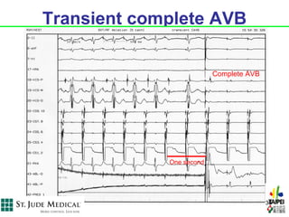 Transient complete AVB

                          Complete AVB




             One second




                                         36
 