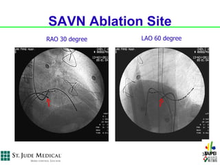 SAVN Ablation Site
RAO 30 degree   LAO 60 degree




                                38
 