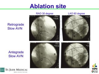 Ablation site
               RAO 30 degree   LAO 60 degree



Retrograde
Slow AVN




Antegrade
Slow AVN
 