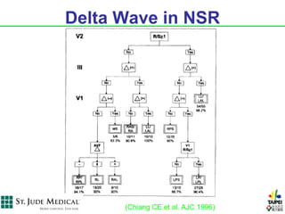 Delta Wave in NSR




      (Chiang CE et al. AJC 1996)
 