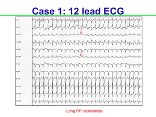 Case 1: 12 lead ECG




       Long RP tachycardia
 