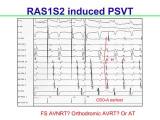 RAS1S2 induced PSVT



                         A H      A




                     CSO-A earliest


  FS AVNRT? Orthodromic AVRT? Or AT
 