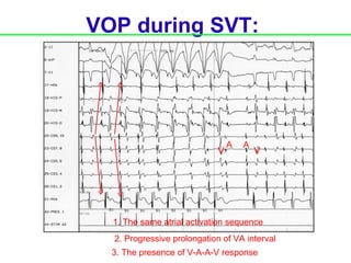 VOP during SVT:




                                A   A
                            V           V




  1. The same atrial activation sequence
  2. Progressive prolongation of VA interval
  3. The presence of V-A-A-V response
 