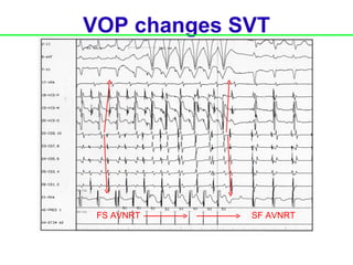 VOP changes SVT




 FS AVNRT    SF AVNRT
 