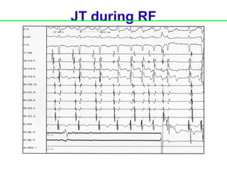 JT during RF
 