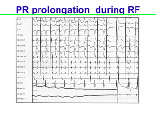 PR prolongation during RF
 