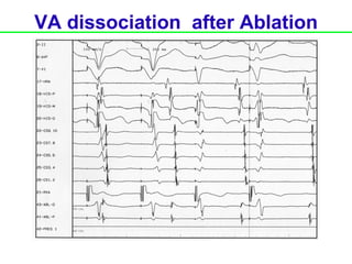 VA dissociation after Ablation
 