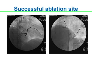 Successful ablation site
 