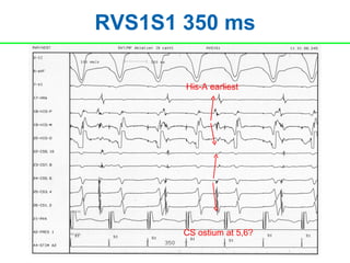 RVS1S1 350 ms

       His-A earliest




       CS ostium at 5,6?
 