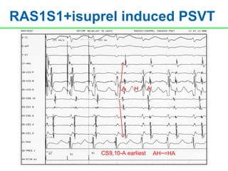 RAS1S1+isuprel induced PSVT



                   A    H       A




            CS9,10-A earliest       AH~=HA
 