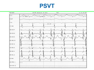 PSVT
 