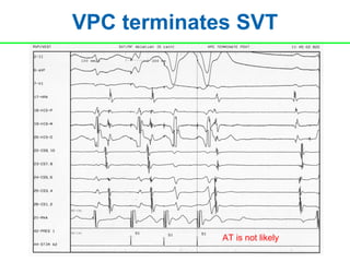 VPC terminates SVT




             AT is not likely
 