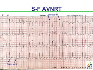 S-F AVNRT
               Pseudo-R’




Pseudo-S
 