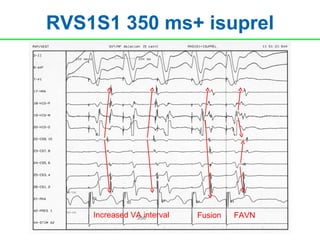 RVS1S1 350 ms+ isuprel




    Increased VA interval   Fusion   FAVN
 