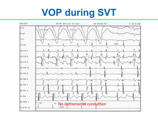 VOP during SVT




   No decremental conduction
 
