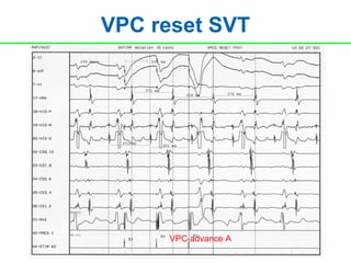 VPC reset SVT




     VPC advance A
 