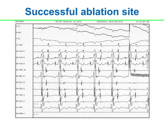 Successful ablation site
 