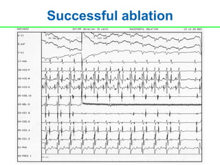 Successful ablation
 