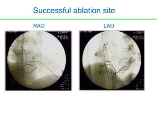 Successful ablation site
RAO                 LAO
 