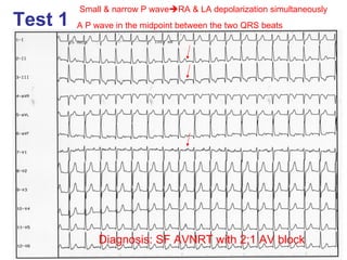 Small & narrow P waveRA & LA depolarization simultaneously
Test 1   A P wave in the midpoint between the two QRS beats




              Diagnosis: SF AVNRT with 2:1 AV block
 