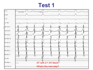 Test 1




AT with 2:1 AV block?
What’s the next step?
 