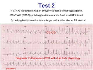Test 2
    A 57 Y/O male patient had an arrhythmic attack during hospitalization.
    PSVT with (RBBB) cycle length alternans and a fixed short RP interval

    Cycle length alternans due to one longer and another shorter PR interval




          Diagnosis: Orthodromic AVRT with dual AVN physiology


Initiation?
 